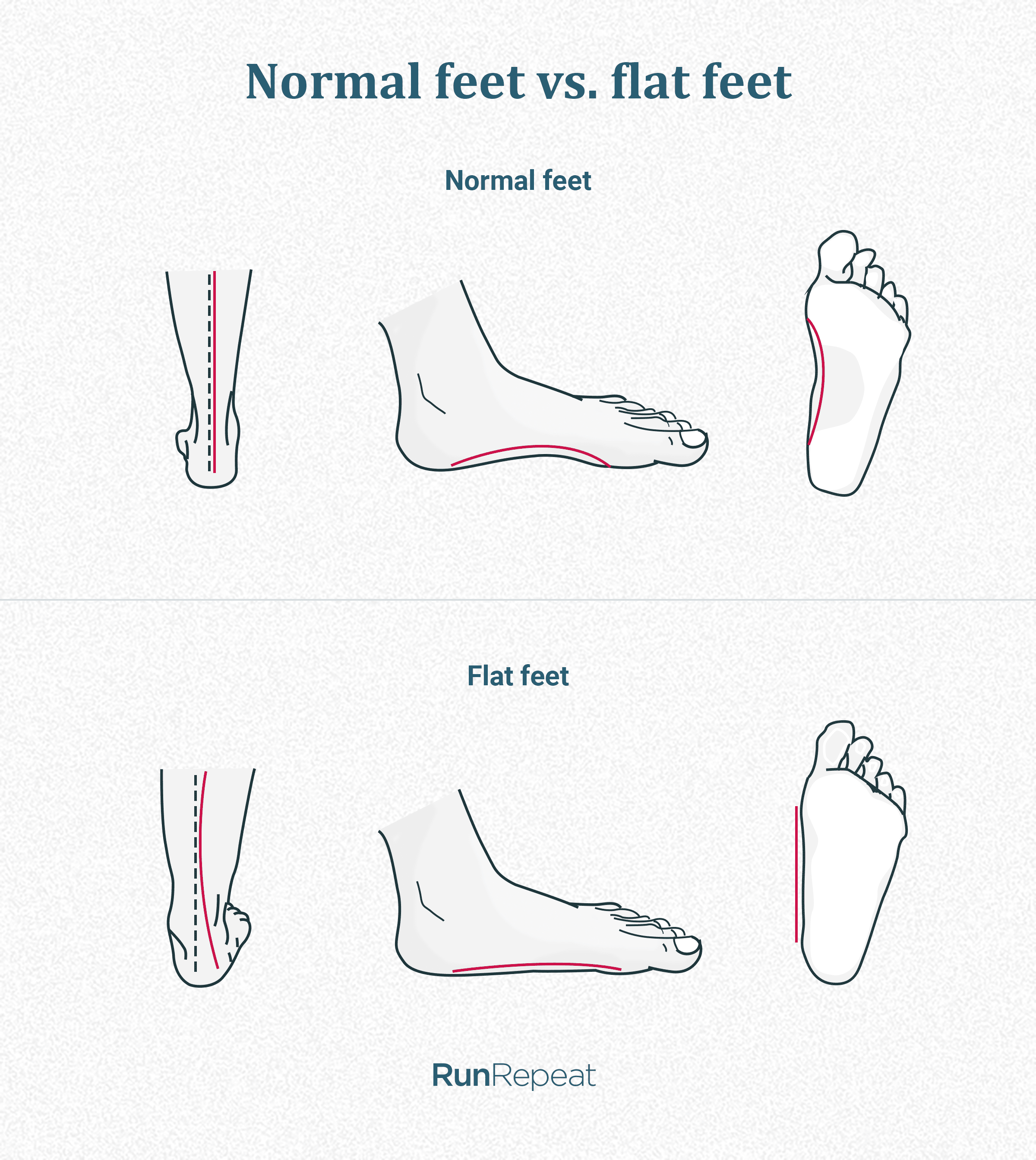 difference-between-normal-and-flat-feet.png